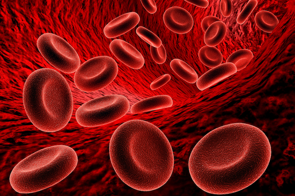 Clinical Cases 1: Anaemia and myelodysplastic syndrome